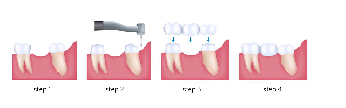 bride-treatment-procedure-dentistkusadasi-2