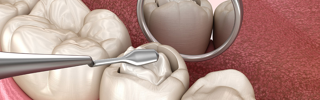 composite-filling-dentistkusadasi-1