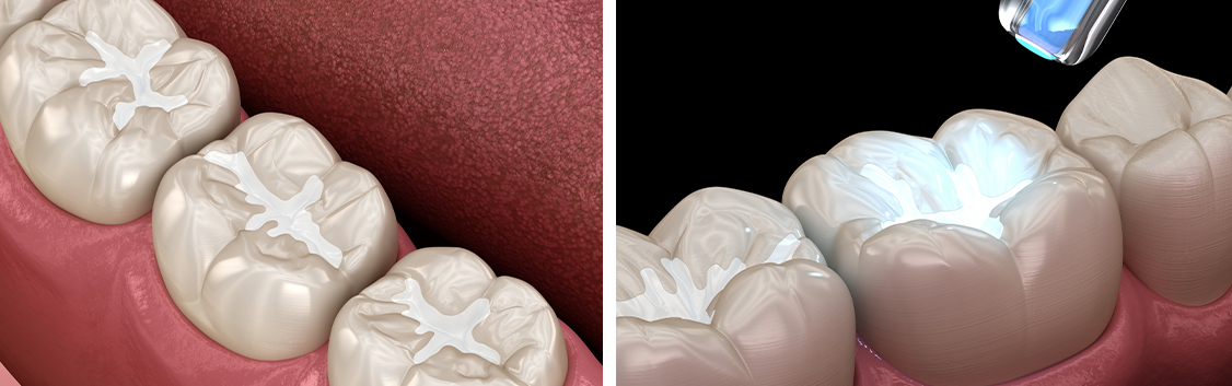 composite-filling-dentistkusadasi-2