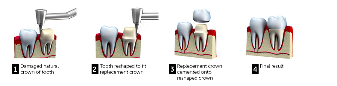 crown-treatment-procedure-dentistkusadasi