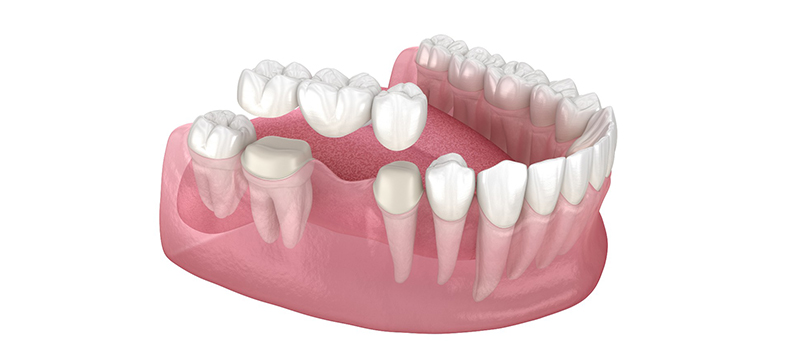 dental-bridge-dentistkusadasi-2