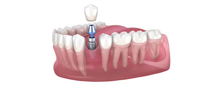 dental-implant-dentistkusadasi-1
