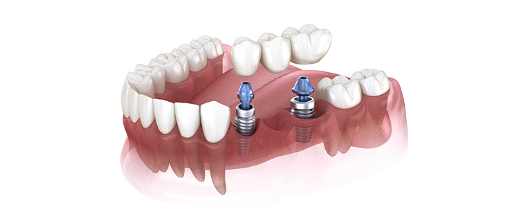 dental-implant-dentistkusadasi-2