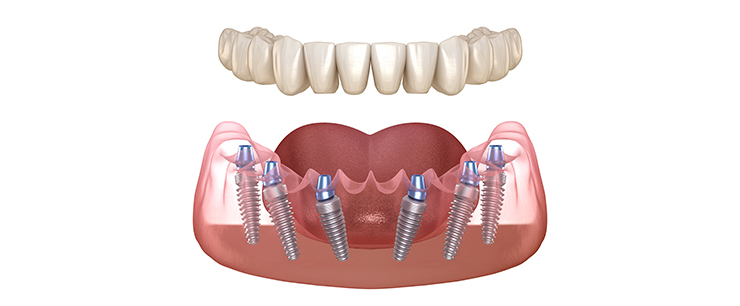 dental-implant-dentistkusadasi-3_1