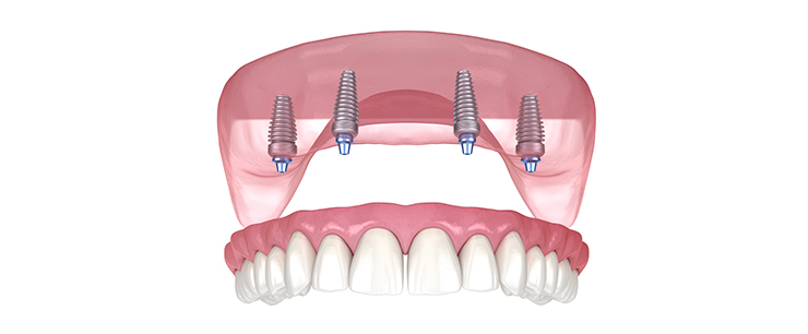 dental-implant-dentistkusadasi-4