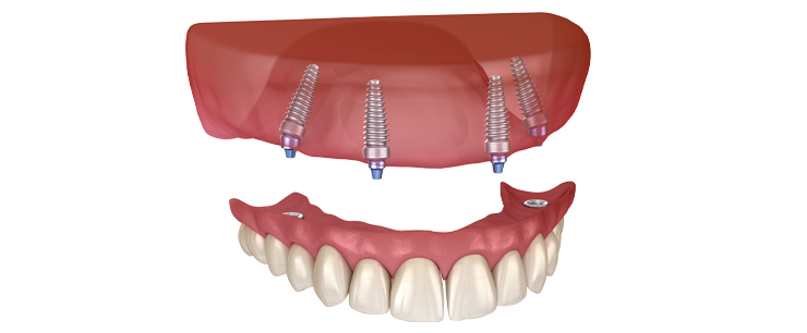 dental-implant-dentistkusadasi-4_1