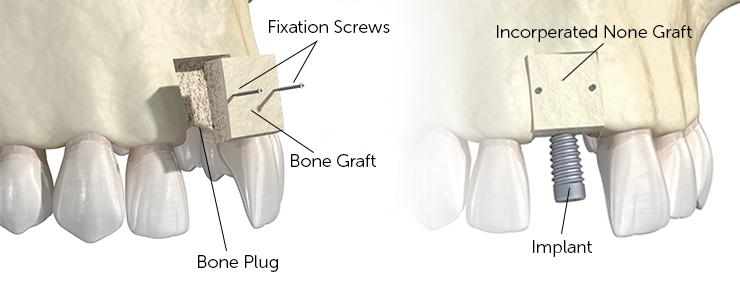 dental-implant-dentistkusadasi-5