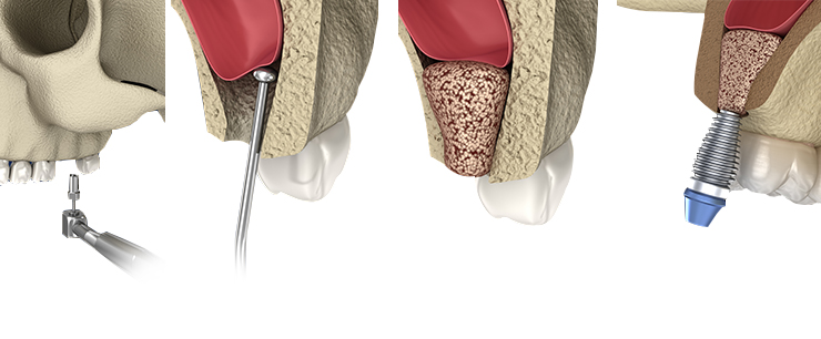dental-implant-dentistkusadasi-6