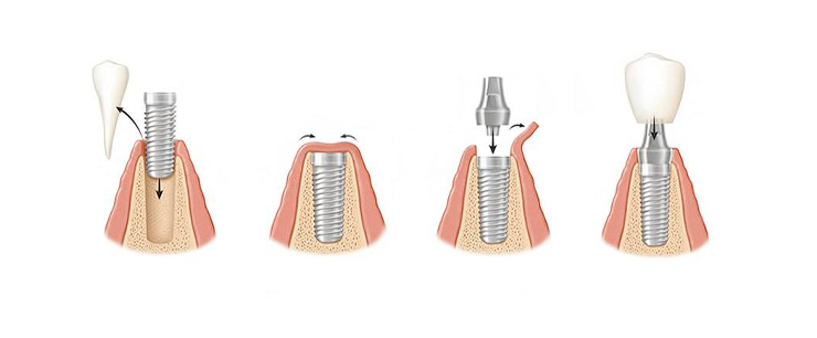 dental-implant-dentistkusadasi-7