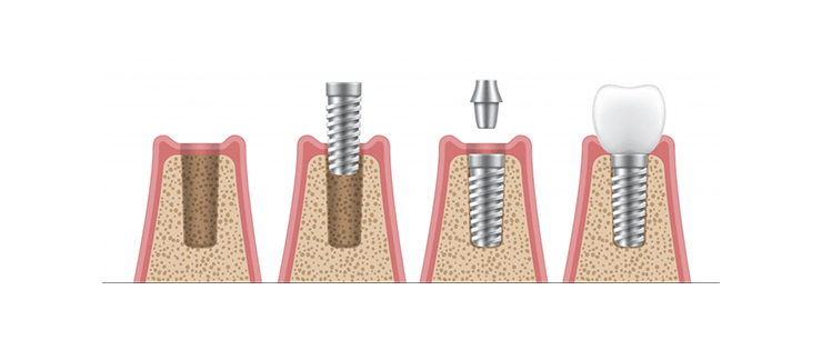 dental-implant-dentistkusadasi-8