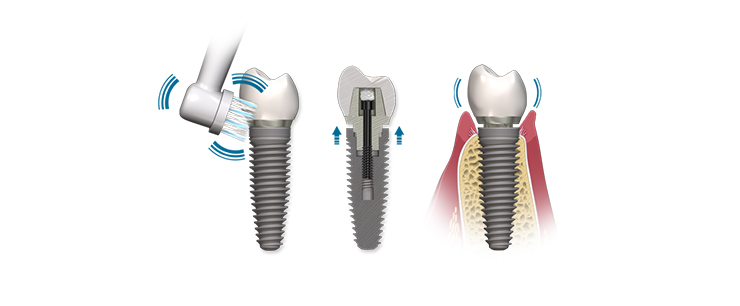 dental-implant-dentistkusadasi-9