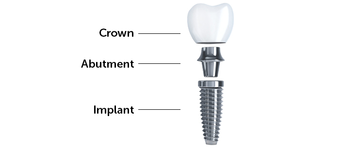 dental-implant-dentistkusadasi