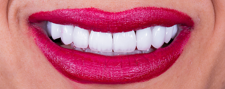 glass-ceramic-crowns-dentistkusadasi_1