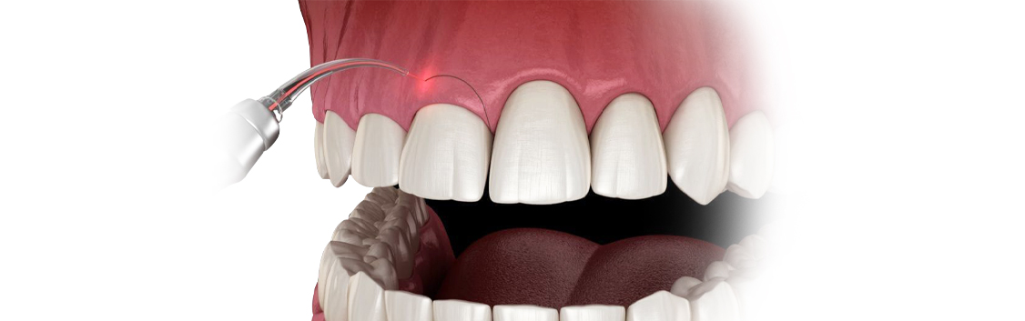 gummy-smile-correction-dentistkusadasi-1