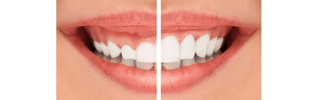 gummy-smile-correction-dentistkusadasi-2