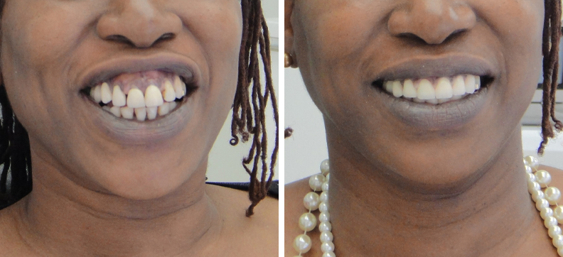 gummy-smile-correction-dentistkusadasi-3