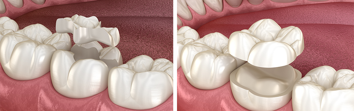 inlay-onlay-dentistkusadasi-1
