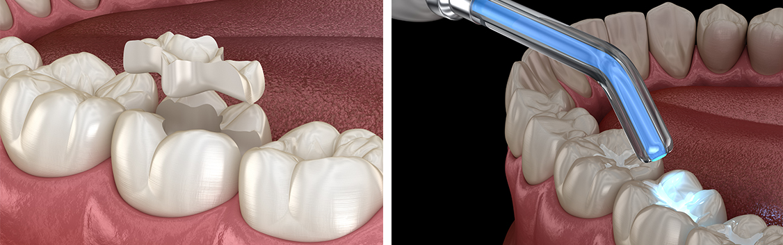 inlay-onlay-dentistkusadasi-2