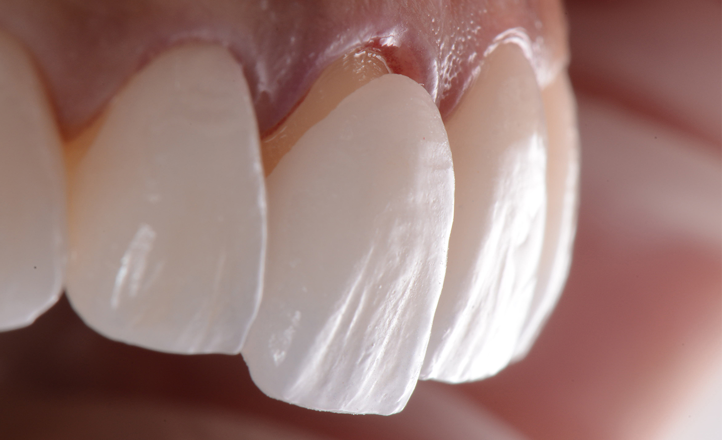 laminate-veneers-dentistkusadasi-2021-1_1
