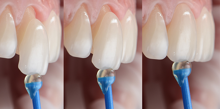 laminate-veneers-dentistkusadasi-2021-2_1