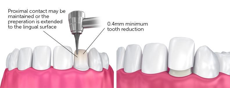 laminate-veneers-dentistkusadasi-2021-4