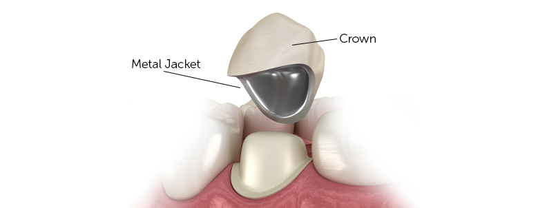 porcelein-crown-dentistkusadasi-2021-2