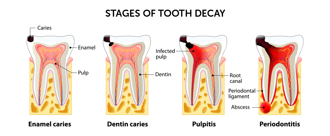 root-canal-treatment-dentistkusadasi-1