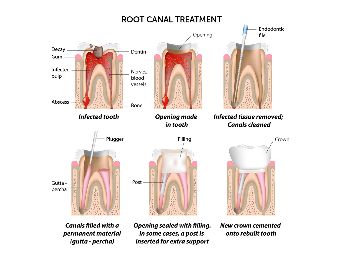 root-canal-treatment-dentistkusadasi-2