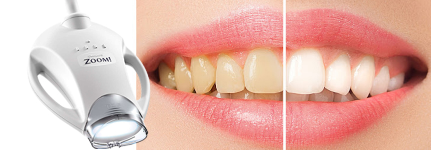 teeth-whitening-dentistkusadasi-2021-2