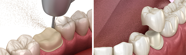 zirconium-crown-replacement